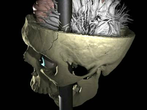 La historia del hombre que sobrevivió con un hierro en la cabeza