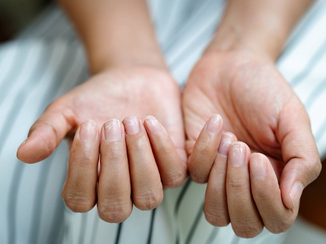 5 motivos por los que se te pueden caer las uñas