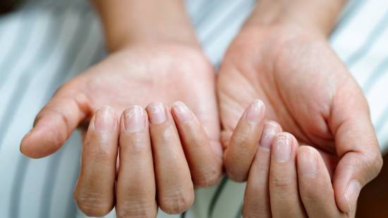 5 motivos por los que se te pueden caer las uñas
