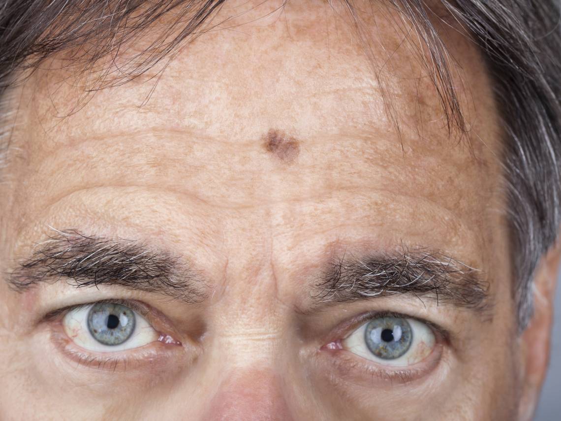 Cara de hombre con melanoma. Cáncer de piel