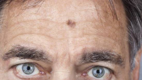 Cara de hombre con melanoma. Cáncer de piel