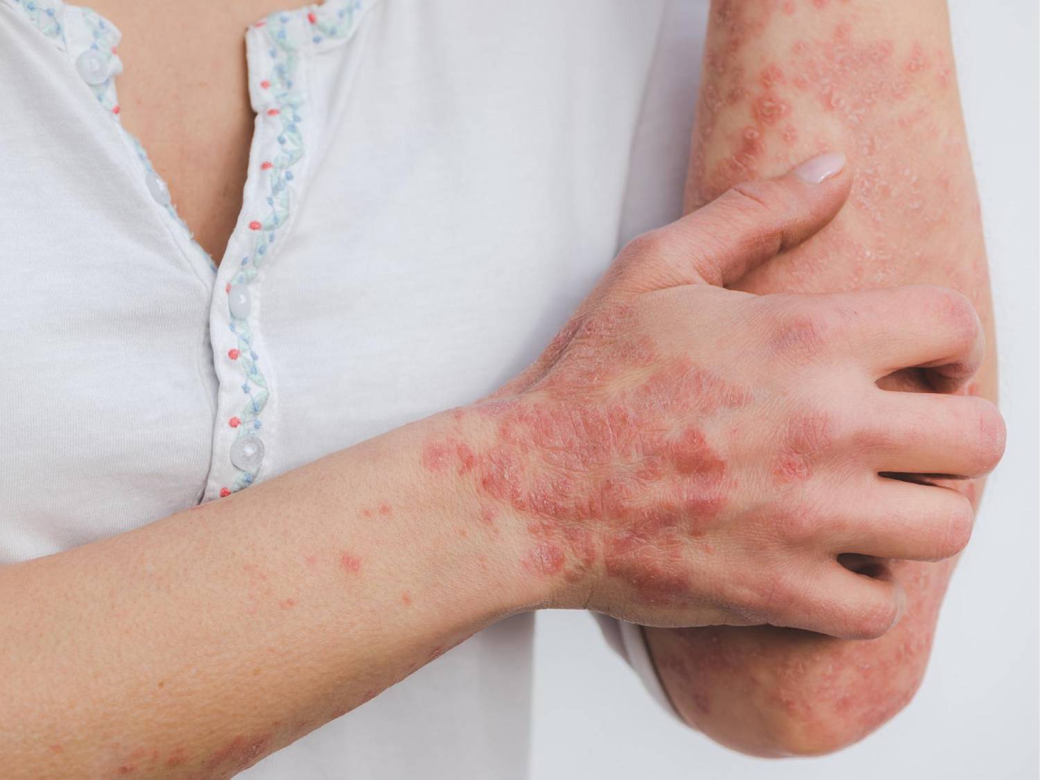 Mujer con con psoriasis en el brazo