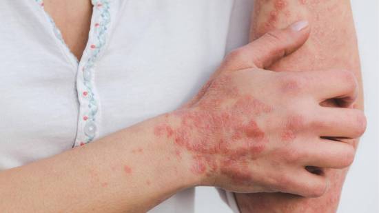 Mujer con con psoriasis en el brazo