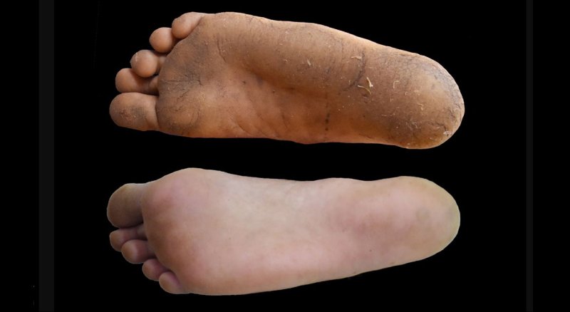 Pies con callos vs. sin callos