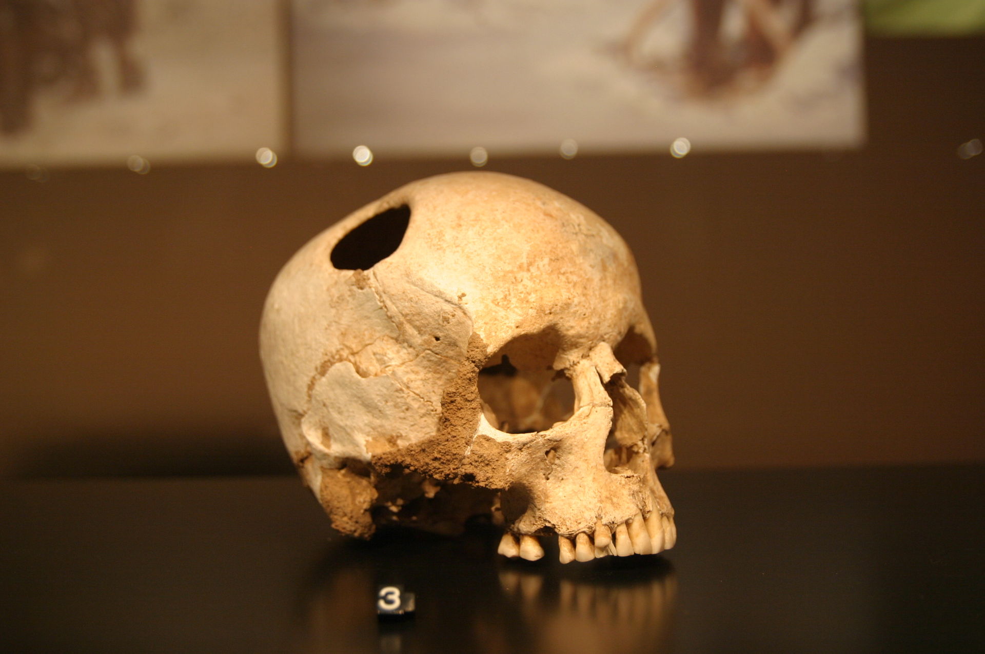 trepanacion1