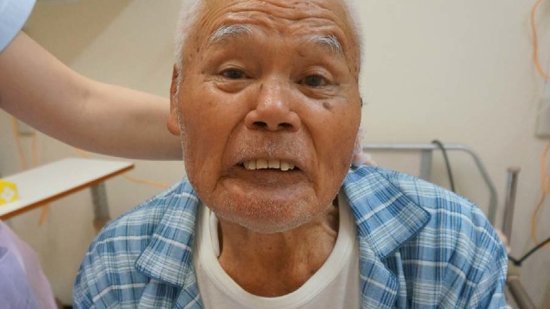 Risus-Sardonicus-face