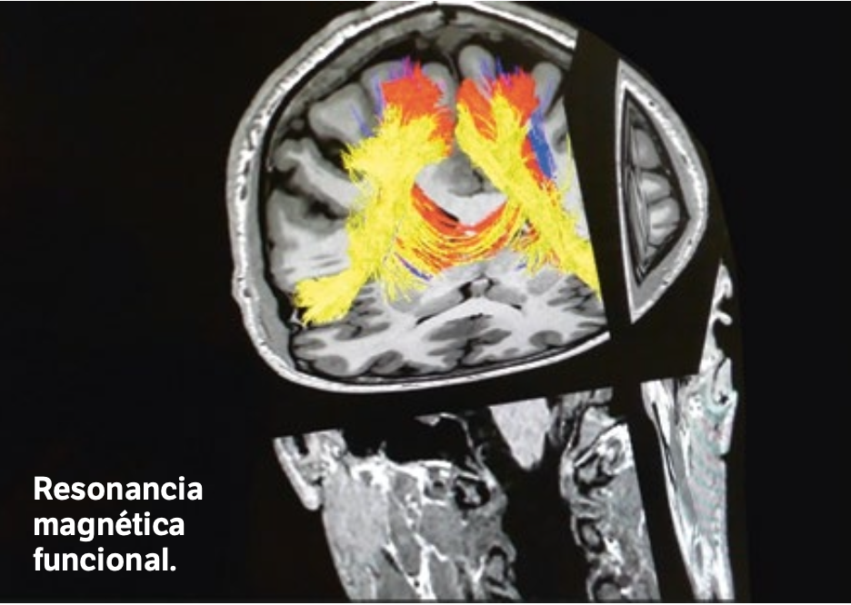 Resonancia magnética funcional