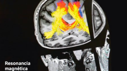 Resonancia magnética funcional