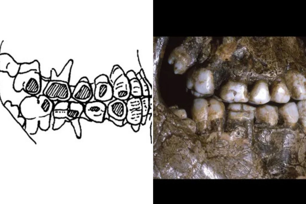 Un caso de desgaste en el esmalte dental en los laterales de los dientes de la Edad de Hielo, hallado en Dolní Věstonice, República Checa