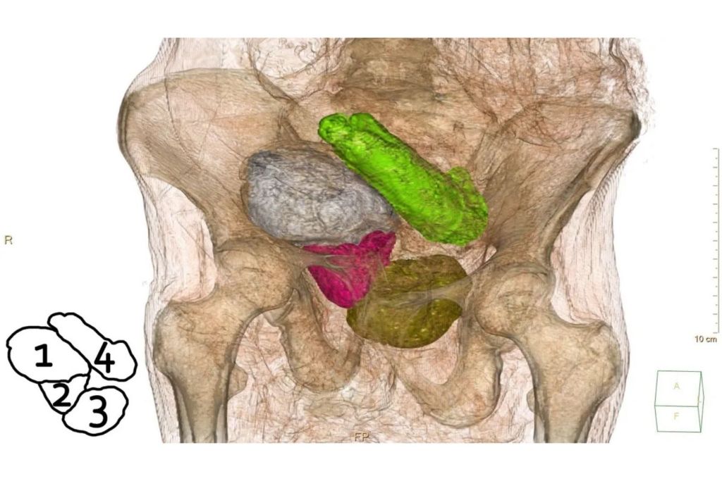 El escaneo por tomografía de la "Dama Misteriosa" revela cuatro estructuras en la pelvis que no corresponden a un feto y que, con toda probabilidad, están vinculadas al proceso de embalsamamiento