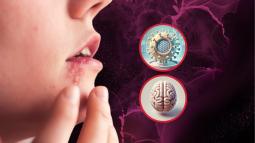 Científicos muestran cómo el herpes daña el cerebro y altera el comportamiento al activar una vía inflamatoria específica