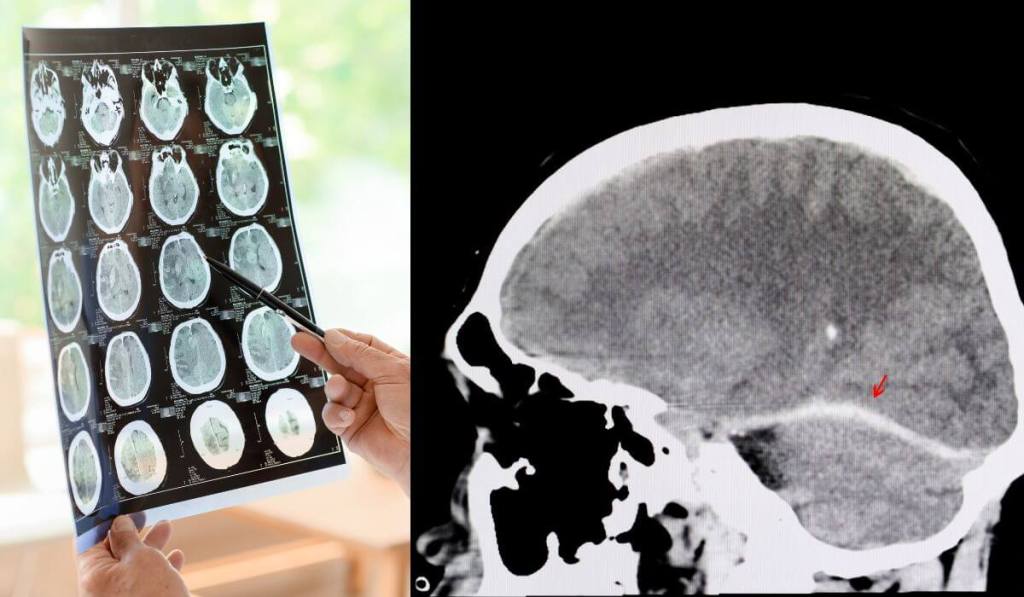 Sébastien Chabal, leyenda del rugby, no recuerda su carrera, la ciencia confirma que el daño cerebral persiste tras el deporte.