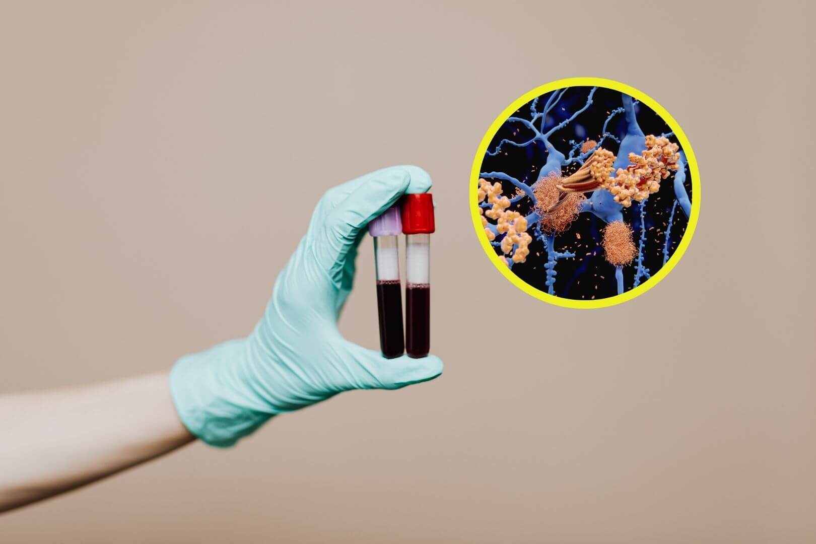 Descubren cómo detectar el alzhéimer con un simple análisis de sangre antes de que avance