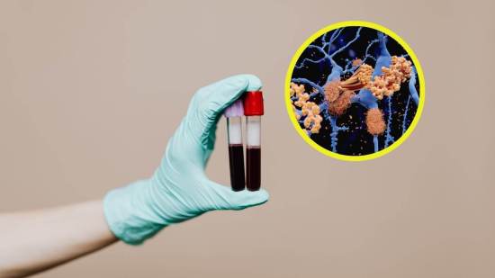 Descubren cómo detectar el alzhéimer con un simple análisis de sangre antes de que avance
