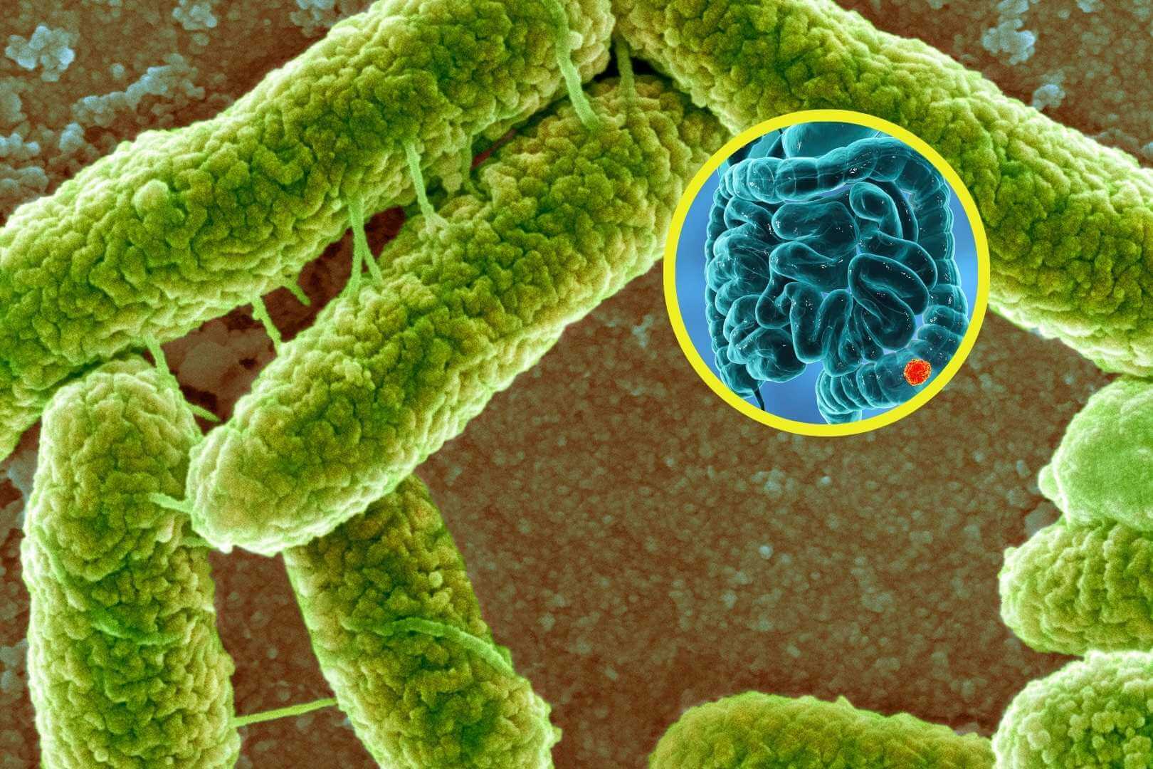 La bacteria que deja una huella en el ADN y podría estar detrás del aumento del cáncer de colon en jóvenes