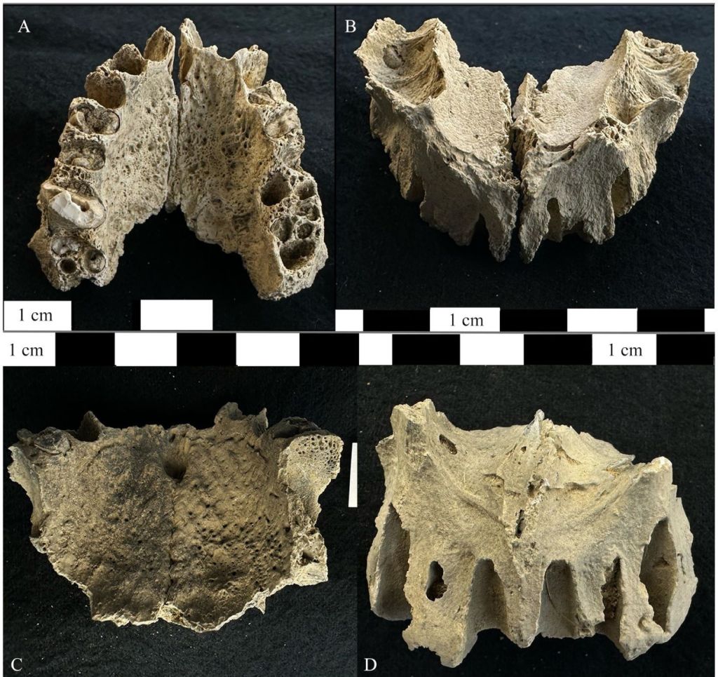 Restos óseos de Omán, lepra