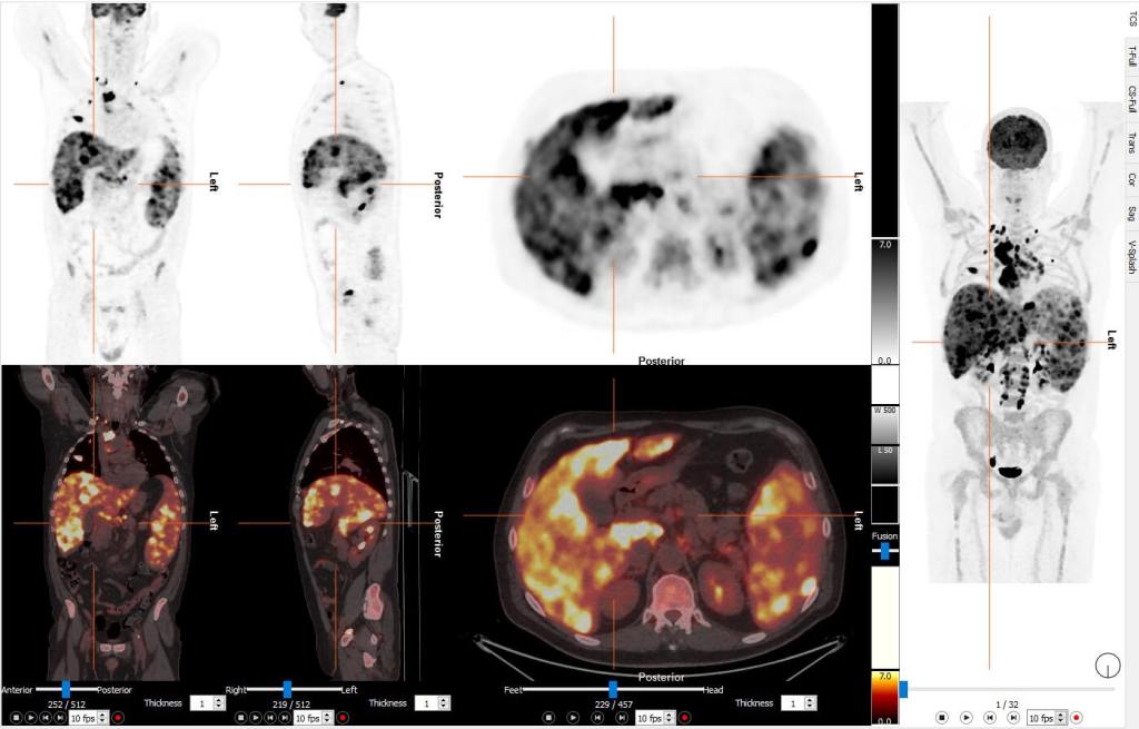 Estadificación inicial con PET FDG en un paciente diagnosticado de linfoma. Créditos: José Manuel Jiménez- Hoyuela García / Rosa María Álvarez Pérez.