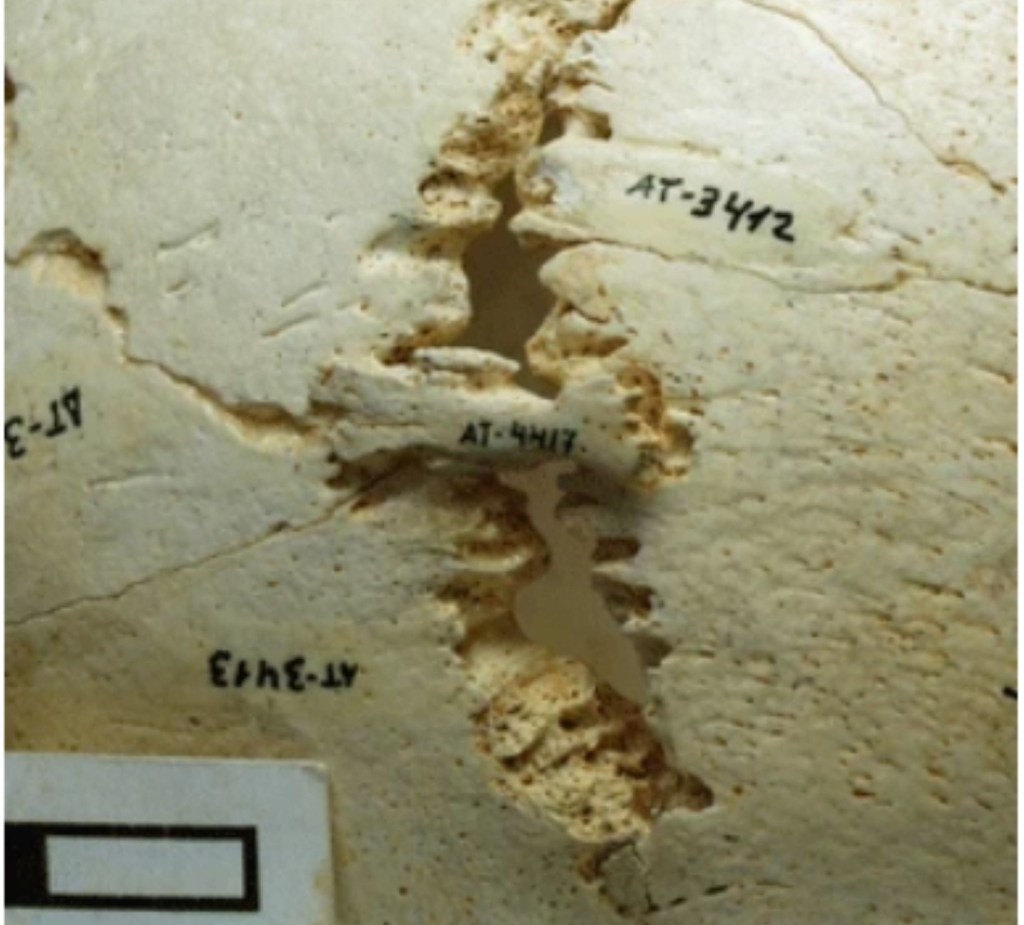 Hueso wormiano en el Cráneo 14