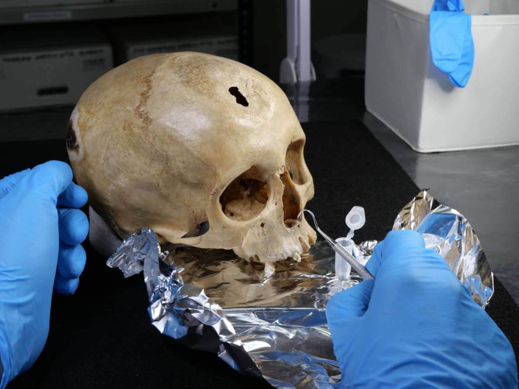 Cráneo expuesto en el Museo de Almería con una trepanación en el frontal con claros signos de supervivencia. En la imagen se observa el momento el momento antes de la extracción de un cálculo dental (Créditos: C. Sobrado y E. Camarós, USC).