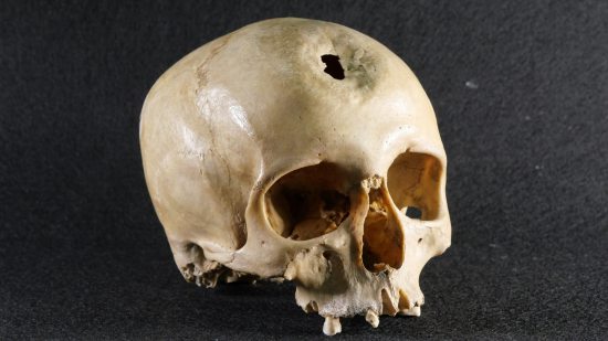 Medicina antes de la medicina, la exploración arqueológica de las primeras cirugías