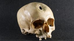 Medicina antes de la medicina, la exploración arqueológica de las primeras cirugías