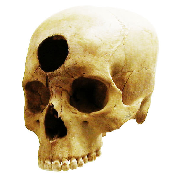 La cirugía más antigua fue la trepanación, practicada hace más de 5.000 años con sorprendentes tasas de supervivencia.