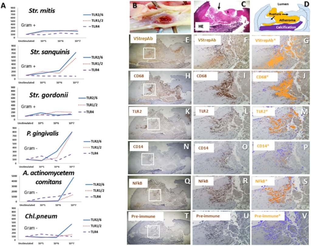 Ruptura fatal de una placa coronaria con biofilm bacteriano: el análisis muestra cómo Streptococcus viridans activa receptores inmunitarios (TLR2, CD14, NF-kB) en la zona dañada, desencadenando una fuerte inflamación. (Journal of the American Heart Association)