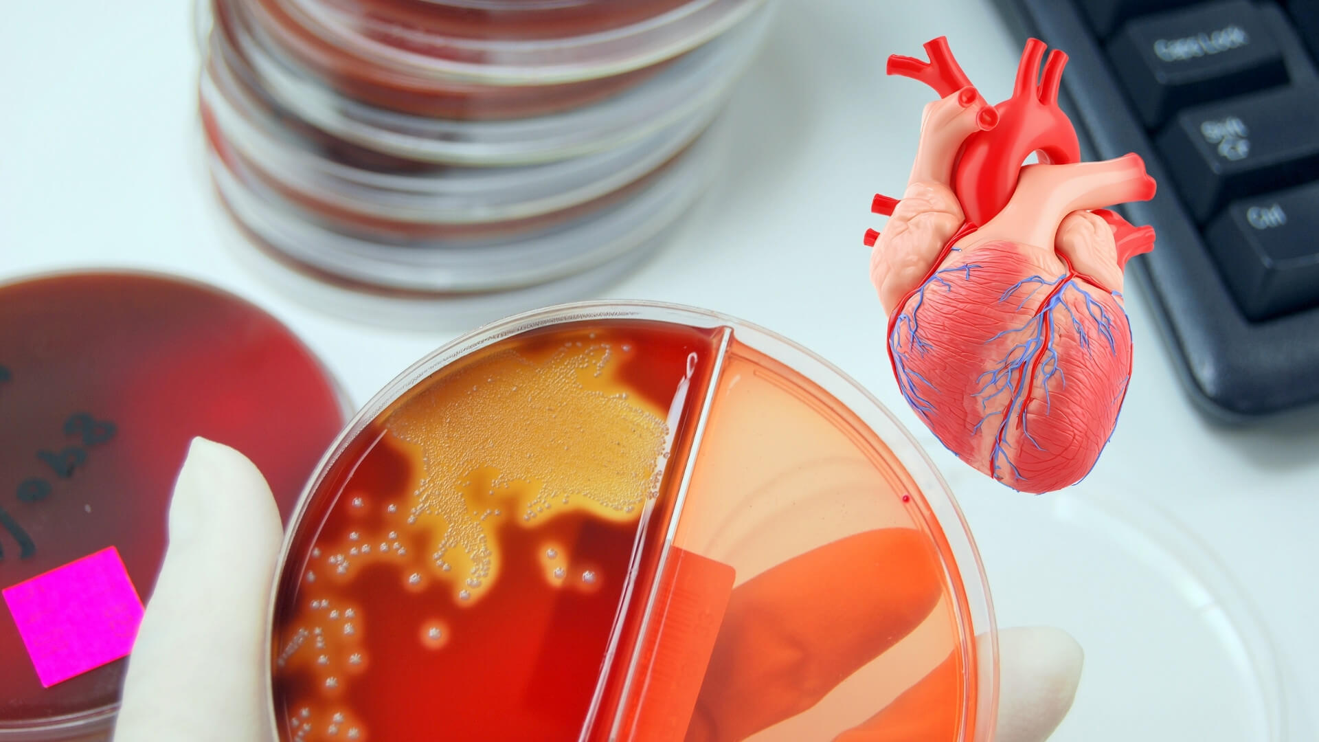 Un hallazgo sorprende a los científicos- bacterias orales se esconden en las arterias y podrían impulsar la ruptura que causa infartos