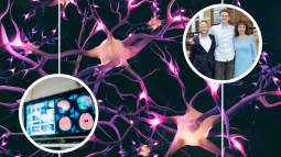 Por primera vez, una terapia génica logra frenar el avance de la enfermedad de Huntington