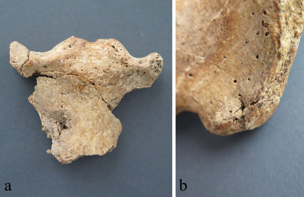 Lesiones de soldados romanos