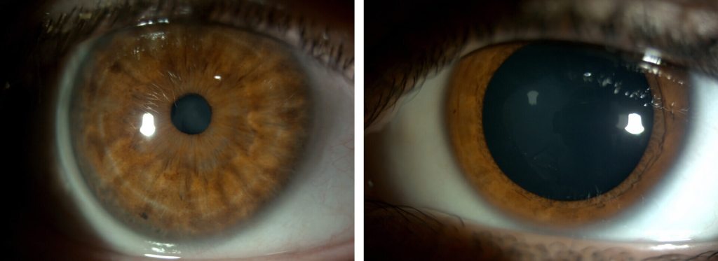 Fotos 1 y 2. Si estos dos ojos tuvieran la misma graduación (miopía, hipermetropía, astigmatismo o vista cansada), sin duda el ojo de la izquierda vería mejor que el de la derecha porque la pupila (la parte negra) es más pequeña.