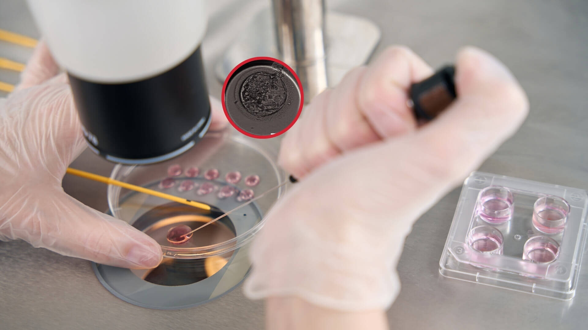 Crean por primera vez embriones humanos usando núcleos de células de la piel y esperma, pero aún no es un tratamiento