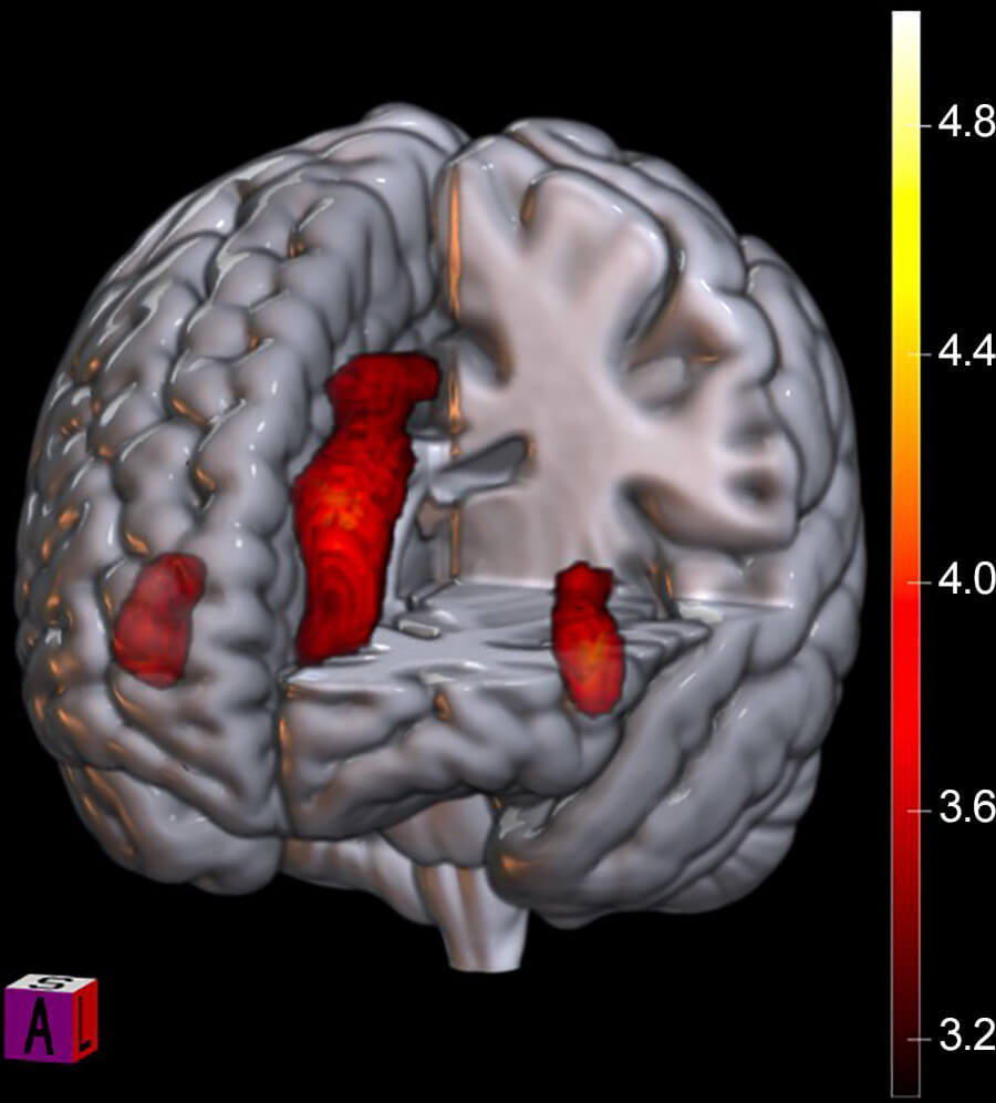 Desactivación durante una derrota significativa: la imagen muestra cómo la red de saliencia reduce su actividad cuando el equipo recibe un gol del archirrival. Créditos: RSNA / Radiology.